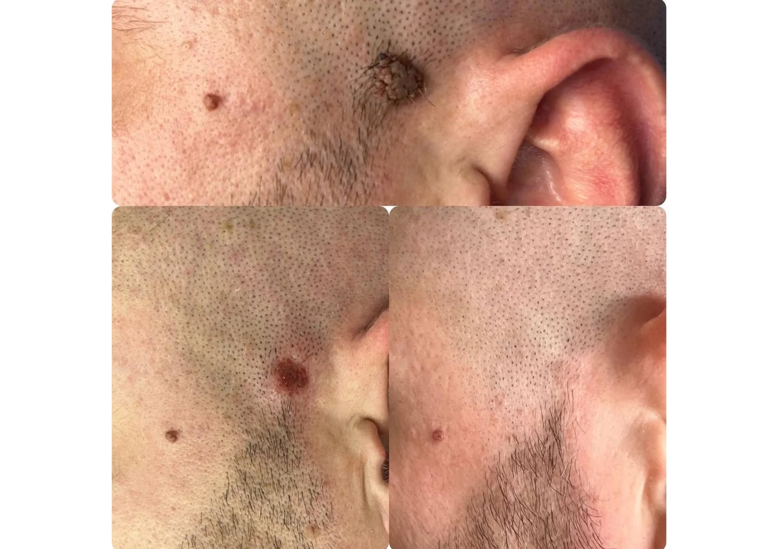 Before and after blemish removal result 1