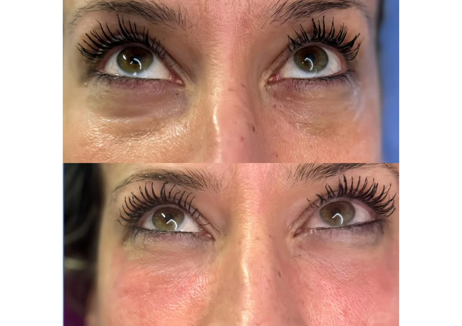 Before and after eye treatment result