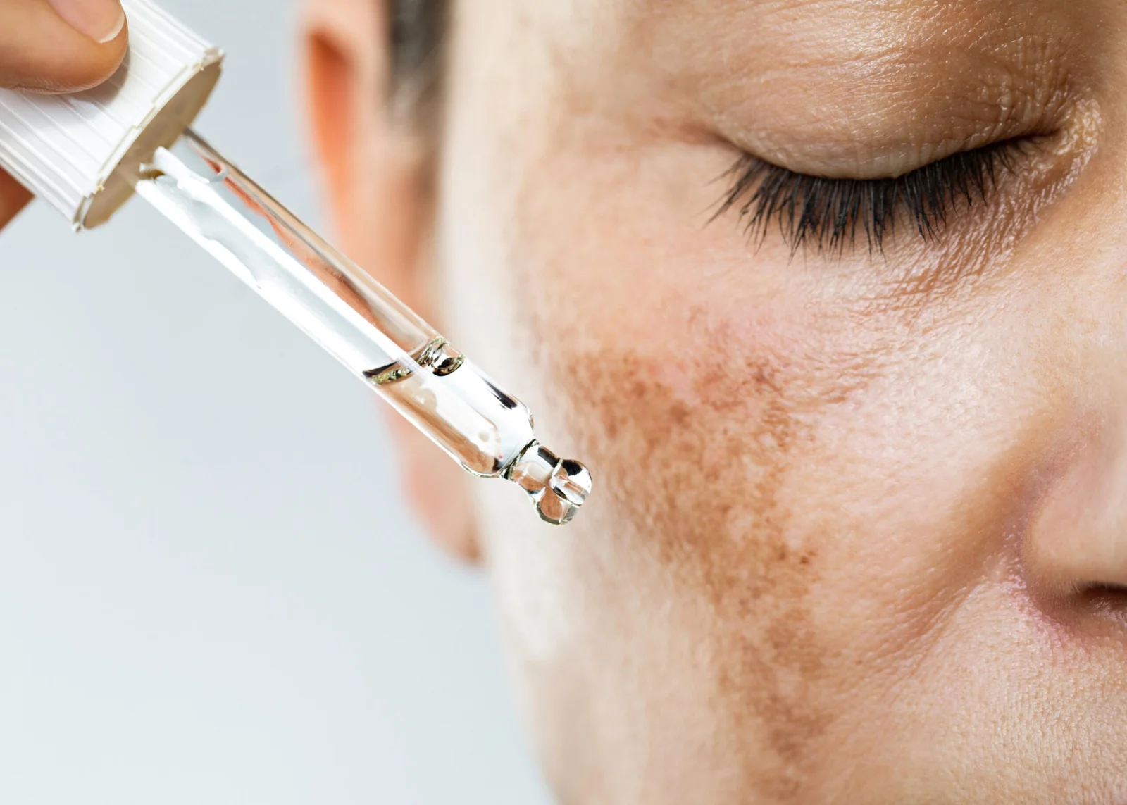 Pigmentation treatment