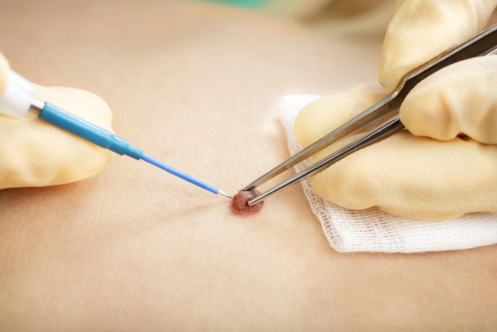 Electrolysis treatment