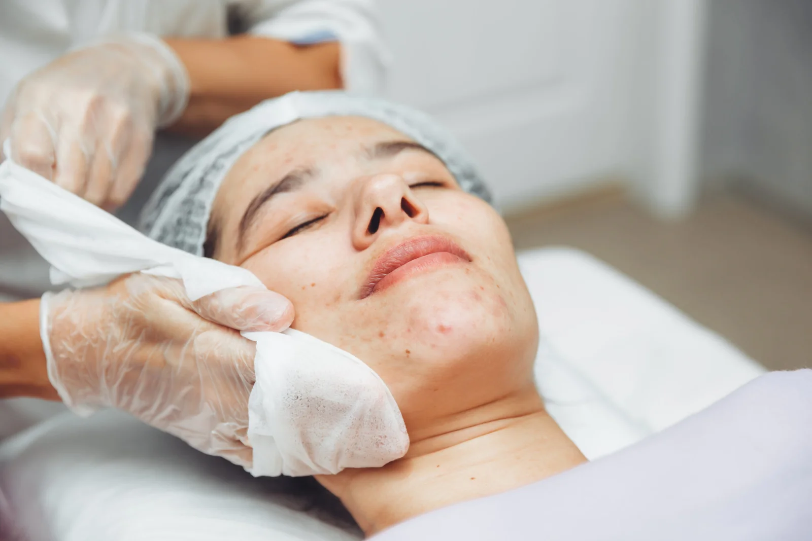 Professional acne cleansing treatment