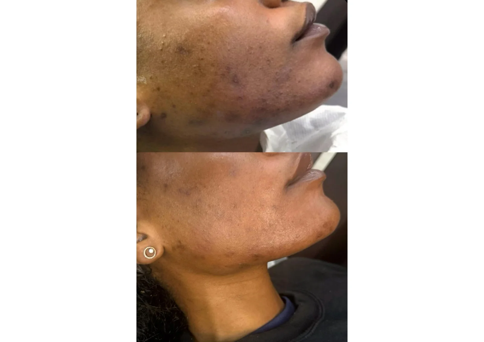 Before and after chemical peel treatment results