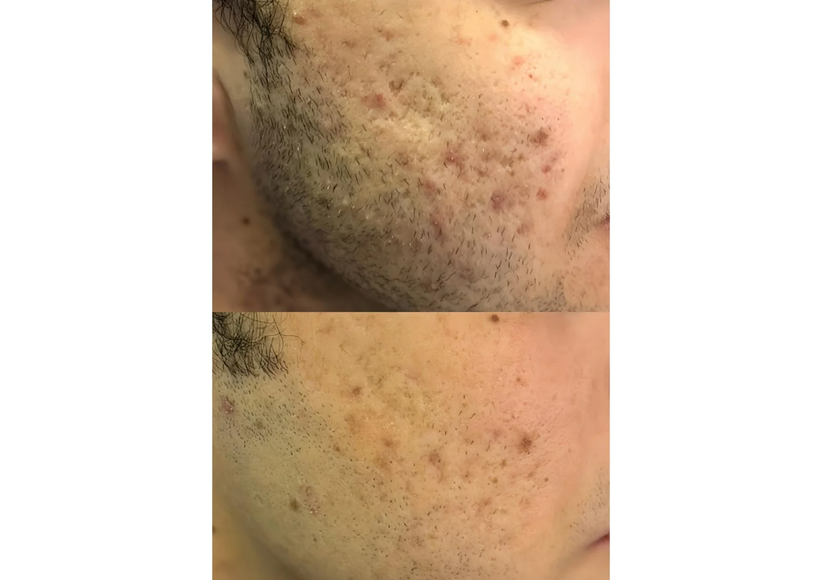 Before and after microneedling result