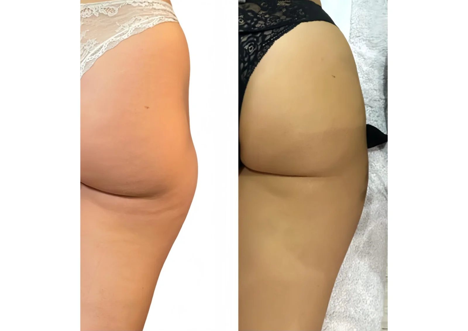 Before and after body contouring result