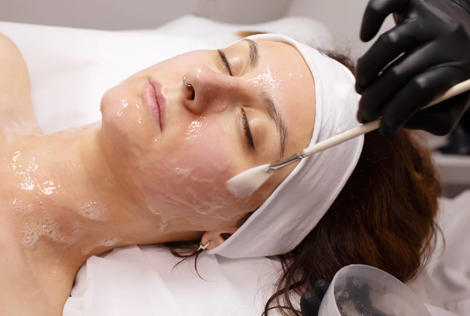 Chemical peel treatment