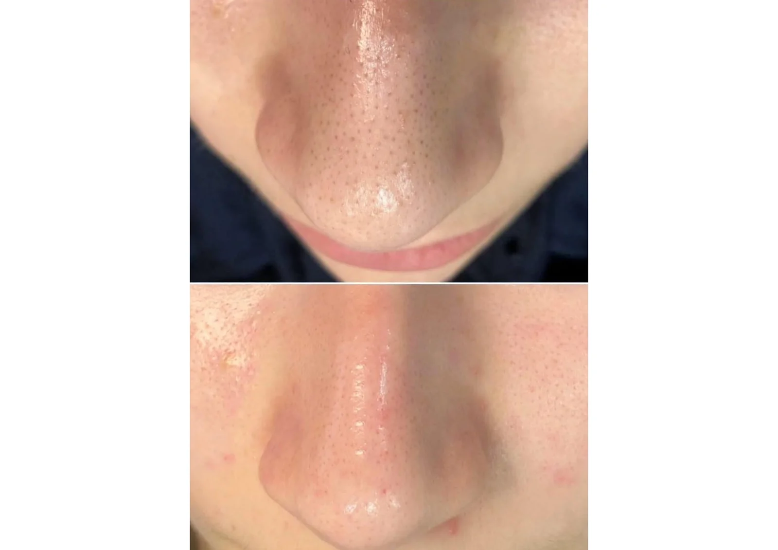 Before and after facial treatment results at Beauty Clinic Brazzini