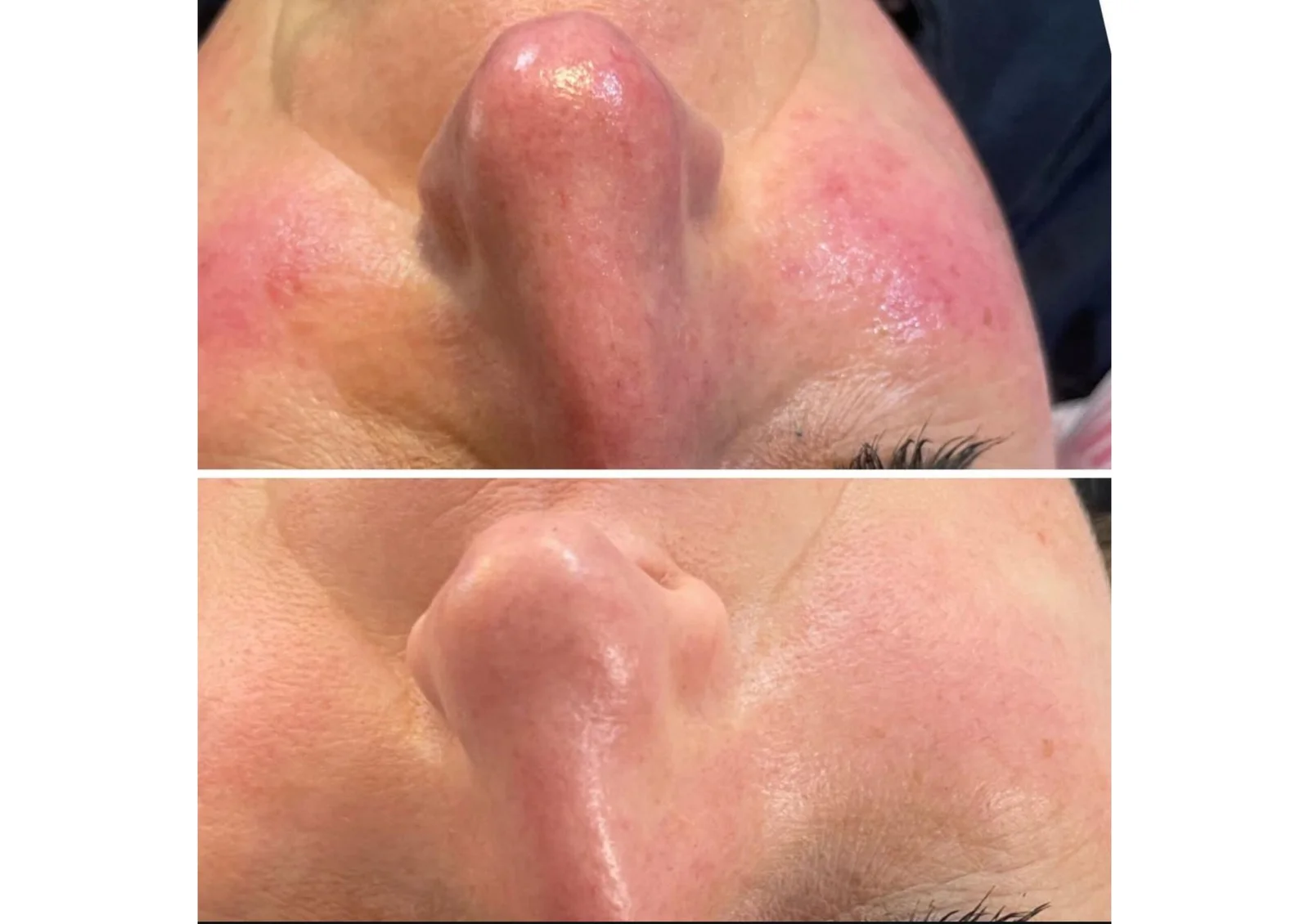 Pigmentation before and after result 1