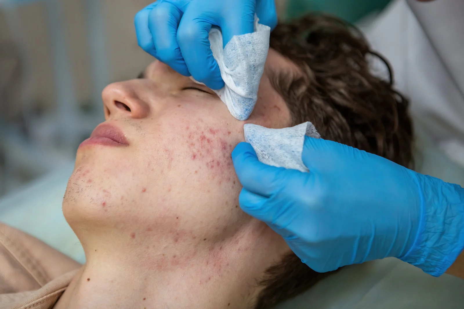 Acne treatment client